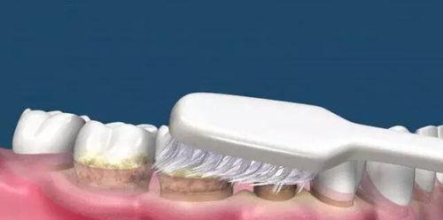 牙结石的清理视频,专业视频教学