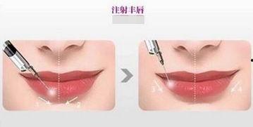 丰唇注射视频